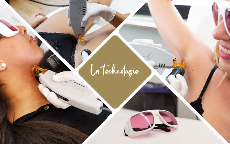 technologie epilation laser comment ca fonctionne